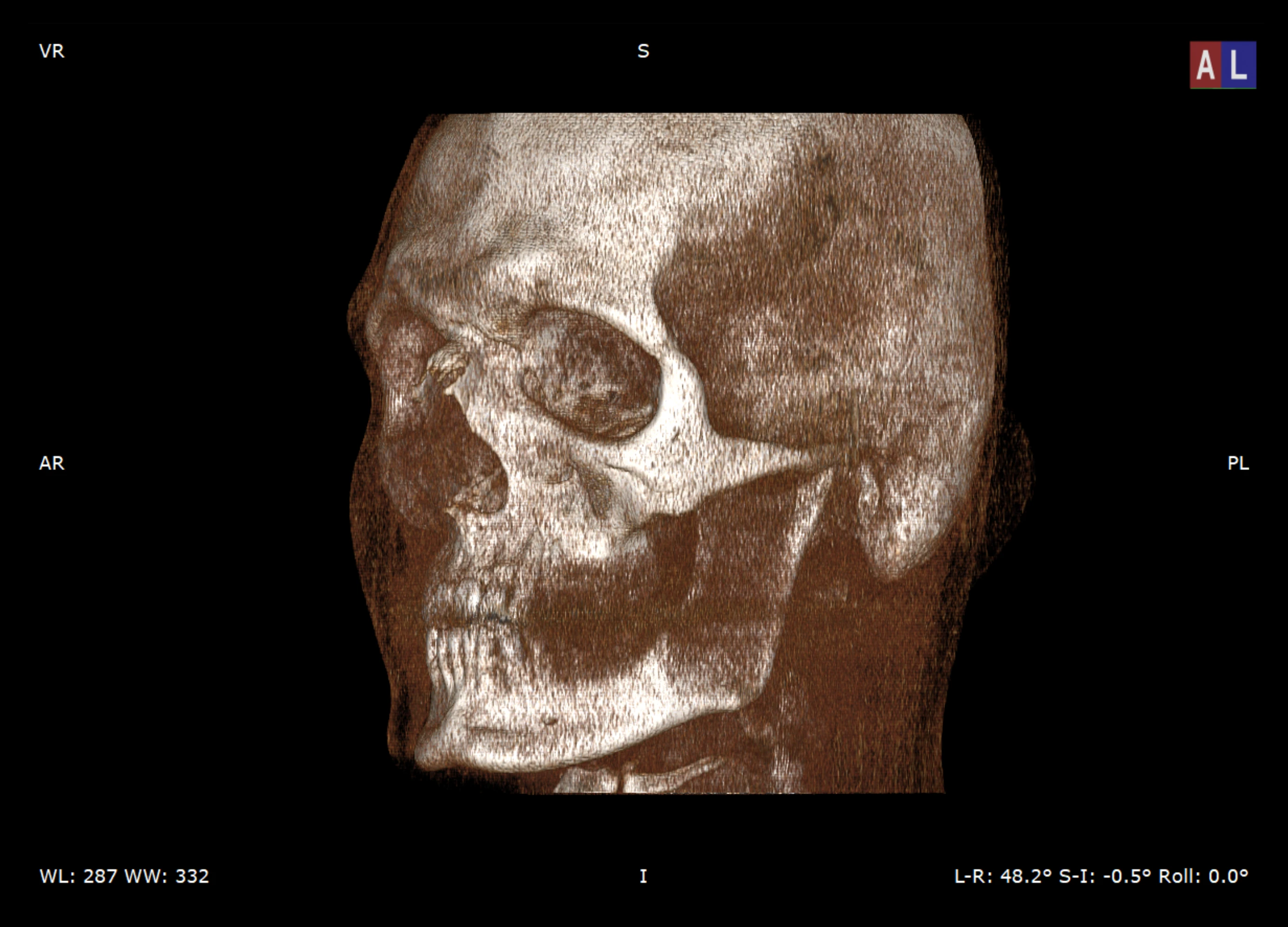 3D Multiplanar Reconstruction of the skull