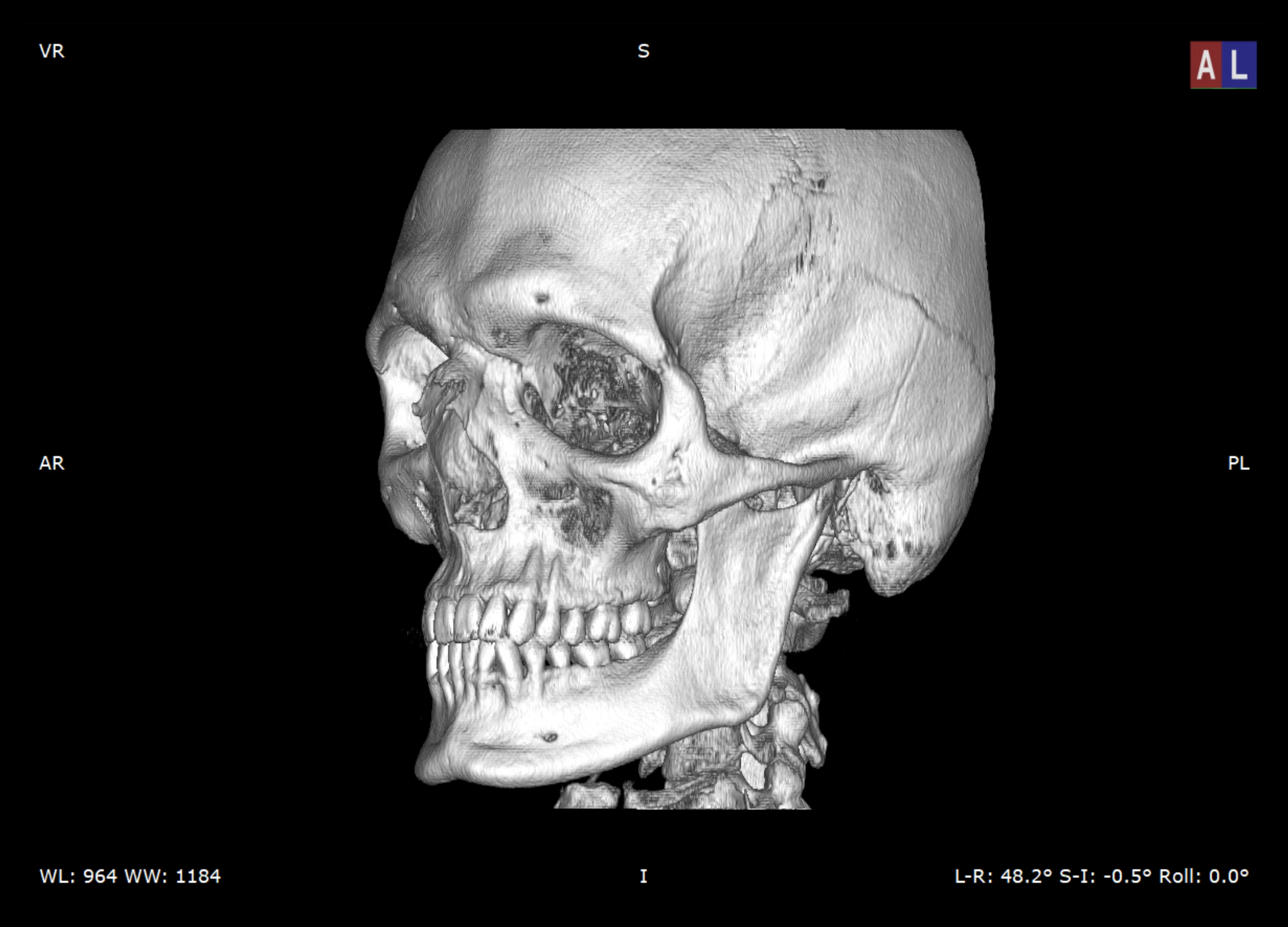 Segmented skull after threshold adjustment